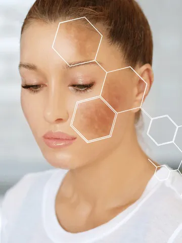 Woman with uneven skin tone and dark spots highlighted
